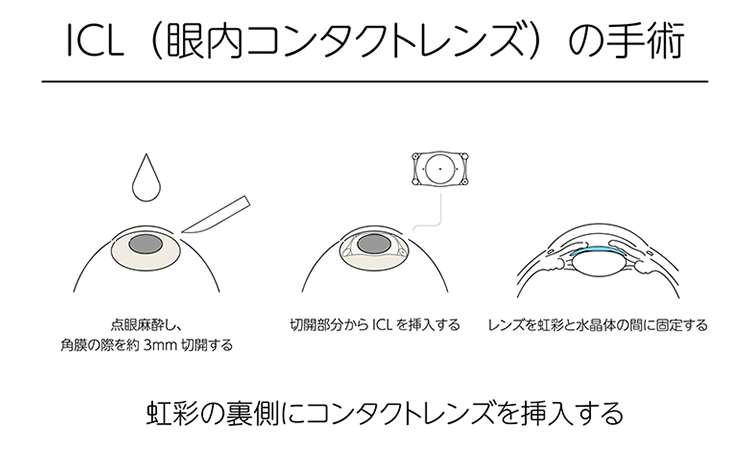 ICL（眼内コンタクトレンズ）の手術